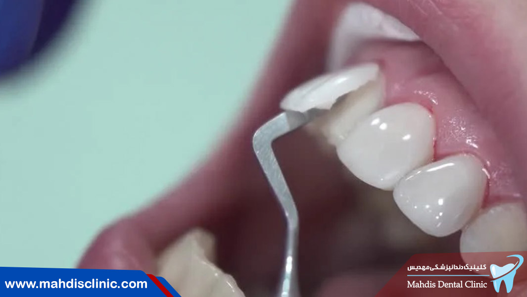 ونیر کامپوزیت و لمینت دندان چه زمانی مفید هستند؟
