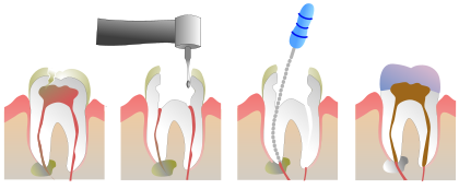 درمان کانال ریشه دندان آسیب دیده