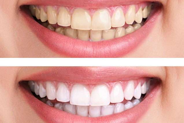 تصویر قبل و بعد بلیچینگ دندان