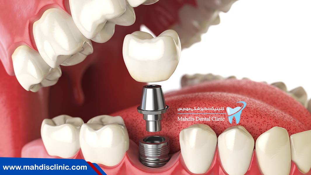 عوارض ایمپلنت دندان در کوتاه مدت