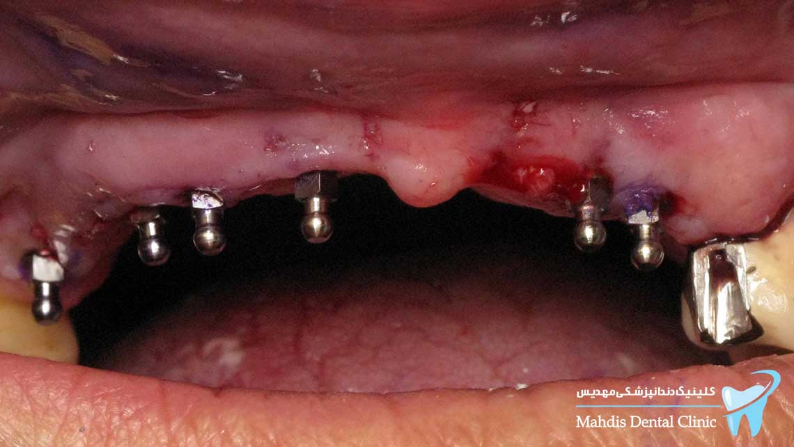 آیا التهاب لثه ایمپلنت همان کارسینومای دهان است؟