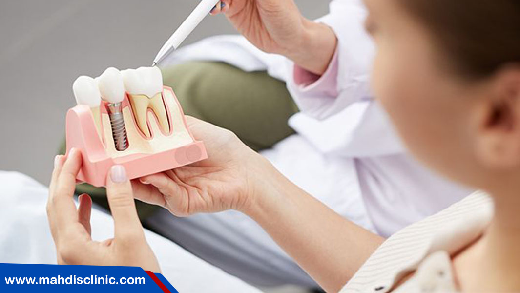 فرق ایمپلنت و روکش دندان چیست؟
