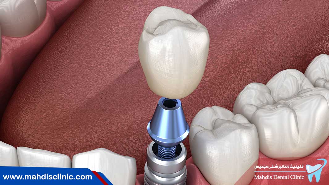 جلوگیری از عفونت ایمپلنت دندان