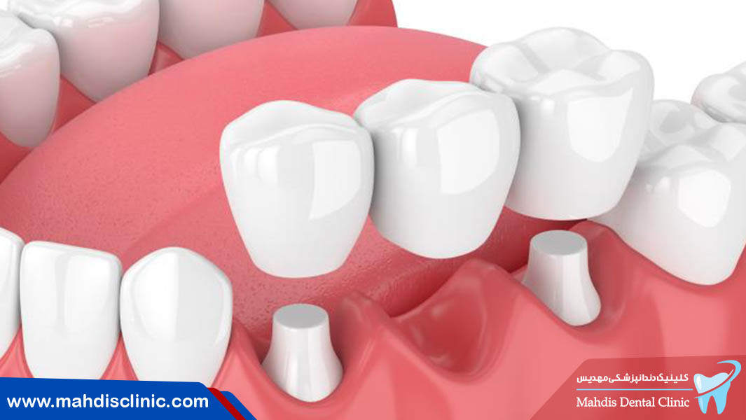 زمان کاشت ایمپلنت دندان