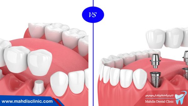دندان از دست رفته را با کدام روش جایگزین کنیم ؟ بریج یا ایمپلنت؟
