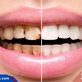 لمینت دندان را زیباتر می سازد یا ونیر کامپوزیت؟