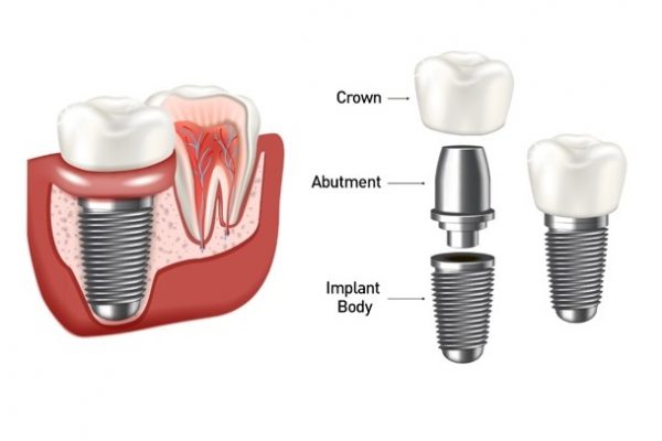 عکس اجزای سیستم ایمپلنت دندان